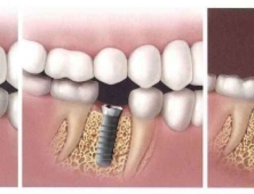 Izrada nadoknada na zubnim implantatima