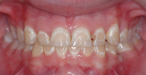 Bele mrlje na zubima (demineralizacija gleđi) nakon skidanja fiksne proteze 