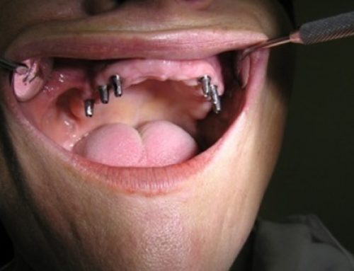 Da li su jeftini zubni implantati kvalitetni