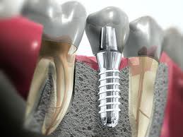 Dentalni implant
