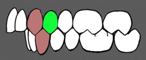 Nepravilan zagrižaj, istureni gornji prednji zubi (protruzija)