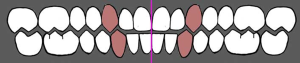 Sredina zubnih nizova se poklapa sa sredinom lica 