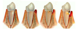 Faze razvoja parodontopatije-1. zdrave desni 2. gingivitis 3. parodontalni džep 4.dalje napredovanje bolesti i razaranje kosti oko zuba