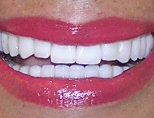 Hollywood smile sa zubnim implantima